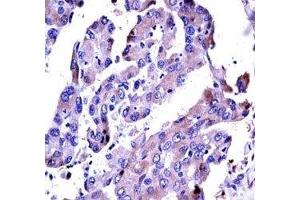 AKT2 antibody immunohistochemistry analysis in formalin fixed and paraffin embedded human lung adenocarcinoma. (AKT2 antibody  (AA 93-123))