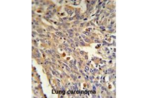 GLA Antibody (N-term) IHC analysis in formalin fixed and paraffin embedded human Lung carcinoma followed by peroxidase conjugation of the secondary antibody and DAB staining. (GLA antibody  (N-Term))