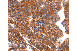 Immunohistochemistry of Human thyroid cancer using SEPT4 Polyclonal Antibody at dilution of 1:50 (Septin 4 antibody)
