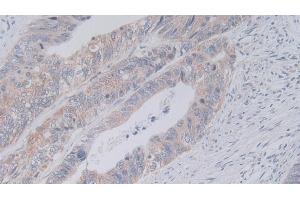 Detection of JAM2 in Human Colorectal cancer Tissue using Polyclonal Antibody to Junctional Adhesion Molecule 2 (JAM2)