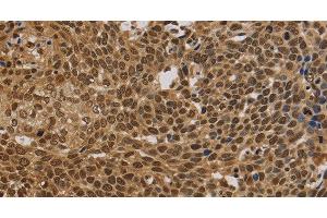Immunohistochemistry of paraffin-embedded Human cervical cancer using BRAF Polyclonal Antibody at dilution of 1:30 (BRAF antibody)