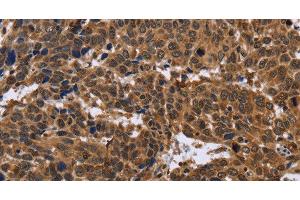 Immunohistochemistry of paraffin-embedded Human cervical cancer using EDN2 Polyclonal Antibody at dilution of 1:30 (Endothelin 2 antibody)