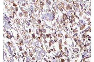 ABIN6278255 at 1/100 staining Human breast cancer tissue by IHC-P. (OS9 antibody  (Internal Region))