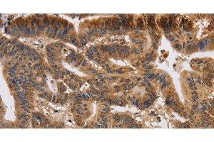 Immunohistochemistry of paraffin-embedded Human colon cancer using KCNK9 Polyclonal Antibody at dilution of 1:40 (KCNK9 antibody)