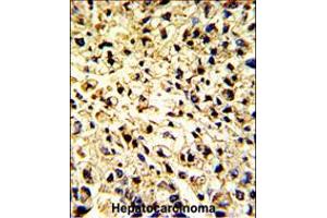 Formalin-fixed and paraffin-embedded human hepatocarcinoma with DCL-1 Antibody , which was peroxidase-conjugated to the secondary antibody, followed by DAB staining. (DCL1 antibody  (AA 143-170))