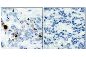 Immunohistochemical analysis of paraffin-embedded human breast carcinoma tissue using Histone H3. (HIST1H3A antibody  (pSer10))