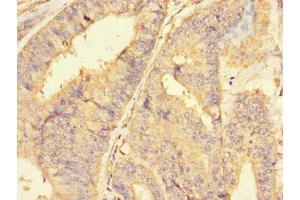 Immunohistochemistry of paraffin-embedded human endometrial cancer using ABIN7150164 at dilution of 1:100 (Retinoblastoma Binding Protein 8 antibody  (AA 126-331))