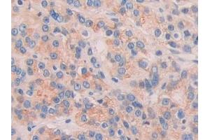 Detection of CHRD in Human Prostate cancer Tissue using Polyclonal Antibody to Chordin (CHRD) (Chordin antibody  (AA 700-918))