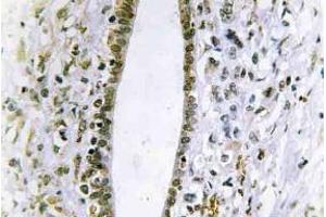 Immunohistochemistry (IHC) analyzes of Fes antibody in paraffin-embedded human liver carcinoma tissue. (FES antibody)