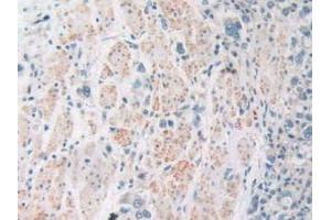 IHC-P analysis of Human Stomach Cancer Tissue, with DAB staining. (SIRT4 antibody  (AA 28-314))