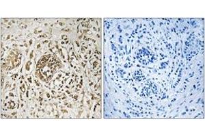 Immunohistochemistry analysis of paraffin-embedded human breast carcinoma tissue, using CIB2 Antibody. (CIB2 antibody  (AA 21-70))