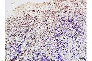 Formalin-fixed and paraffin embedded Human endometrium carcinoma labeled Anti-Livin Polyclonal Antibody, Unconjugated (ABIN672561) at 1:200, followed by conjugation to the secondary antibody and DAB staining (BIRC7 antibody  (AA 101-200))