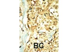 Formalin-fixed and paraffin-embedded human cancer tissue reacted with the primary antibody, which was peroxidase-conjugated to the secondary antibody, followed by DAB staining. (TNIK antibody  (N-Term))