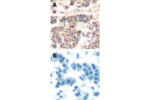 Immunohistochemical analysis of paraffin-embedded human breast carcinoma tissue using IKBKA/IKBKB polyclonal antibody . (IKK alpha antibody  (Ser180, Ser181))