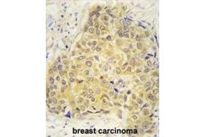 Formalin-fixed and paraffin-embedded human breast carcinoma tissue reacted with SEA antibody (Center) (ABIN392177 and ABIN2841890) , which was peroxidase-conjugated to the secondary antibody, followed by DAB staining.