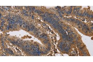 Immunohistochemistry of paraffin-embedded Human colon cancer tissue using KCNG1 Polyclonal Antibody at dilution 1:40 (KCNG1 antibody)