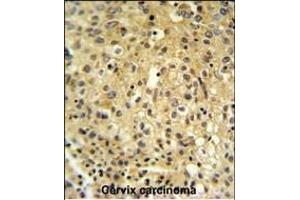 FYTD1 Antibody (N-term) (ABIN651416 and ABIN2840226) IHC analysis in formalin fixed and paraffin embedded human cervix carcinoma followed by peroxidase conjugation of the secondary antibody and DAB staining. (FYTTD1 antibody  (N-Term))