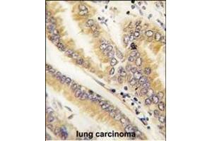 Formalin-fixed and paraffin-embedded human lung carcinoma tissue reacted with AGR2 antibody (N-term) (ABIN390226 and ABIN2840703) , which was peroxidase-conjugated to the secondary antibody, followed by DAB staining.