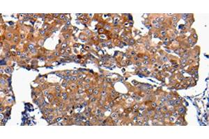 Immunohistochemistry of paraffin-embedded Human breast cancer using FGF2 Polyclonal Antibody at dilution of 1:100 (FGF2 antibody)