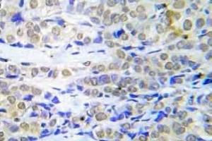 Immunohistochemistry (IHC) analyzes of FOXO4 antibody in paraffin-embedded human lung adenocarcinoma tissue. (FOXO4 antibody)