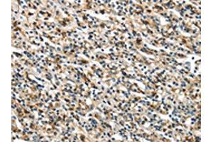 The image on the left is immunohistochemistry of paraffin-embedded Human prostate cancer tissue using ABIN7129612(GLP2R Antibody) at dilution 1/30, on the right is treated with fusion protein. (GLP2R antibody)