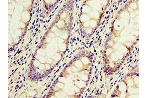 Immunohistochemistry of paraffin-embedded human colon cancer using ABIN7143229 at dilution of 1:100 (ACSM3 antibody  (AA 387-586))