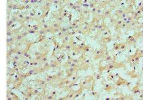 Immunohistochemistry of paraffin-embedded human liver cancer using ABIN7145593 at dilution of 1:100 (SULT2A1 antibody  (AA 1-145))