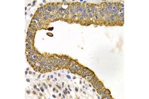 Immunohistochemistry of paraffin-embedded human metrocarcinoma using KRT5 antibody at dilution of 1:200 (400x lens). (Cytokeratin 5 antibody)