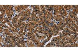 Immunohistochemistry of paraffin-embedded Human thyroid cancer using HSD3B7 Polyclonal Antibody at dilution of 1:40 (HSD3B7 antibody)