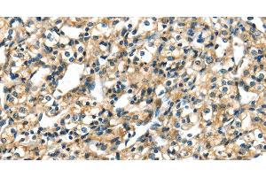 Immunohistochemistry of paraffin-embedded Human prostate cancer tissue using CK-17 Polyclonal Antibody at dilution 1:40 (KRT17 antibody)