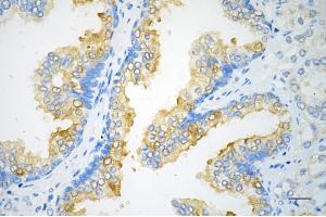 Immunohistochemistry was performed on paraffin-embedded human prostatic adenocarcinoma using NFKB inhibitor alpha antibody (ABIN7799641), 1:200).