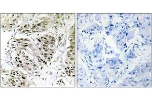 Immunohistochemistry analysis of paraffin-embedded human breast carcinoma, using CENPA Antibody. (CENPA antibody  (AA 11-60))