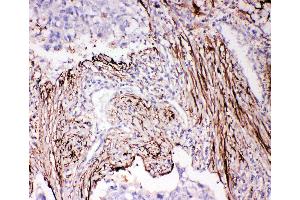 Anti-ADAM19 antibody, IHC(P) IHC(P): Human Lung Cancer Tissue
