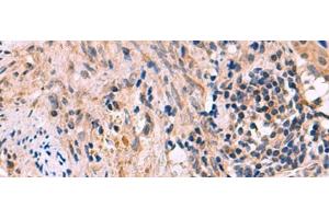 Immunohistochemistry of paraffin-embedded Human cervical cancer tissue using KCNIP1 Polyclonal Antibody at dilution of 1:60(x200)