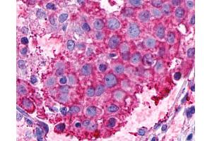 Anti-GPR116 antibody IHC of human Breast, Carcinoma. (G Protein-Coupled Receptor 116 antibody  (N-Term))