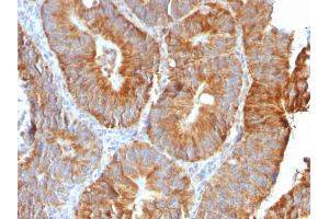 Formalin-fixed, paraffin-embedded human Colon Carcinoma stained with VEGI Rabbit Recombinant Monoclonal Antibody (VEGI /2052R). (Recombinant TNFSF15 antibody)