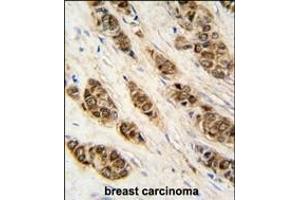 Formalin-fixed and raffin-embedded human breast carcinoma tissue reacted with XTP3T antibody (N-term), which was peroxidase-conjugated to the secondary antibody, followed by DAB staining. (DCTPP1 antibody  (N-Term))