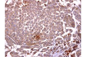 IHC-P Image Glycophorin A antibody [C1C3] detects Glycophorin A protein at cytosol on human lung carcinoma by immunohistochemical analysis. (CD235a/GYPA antibody  (C-Term))