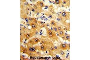 Formalin-fixed and paraffin-embedded human hepatocarcinoma reacted with RPS15 Antibody (N-term), which was peroxidase-conjugated to the secondary antibody, followed by DAB staining.