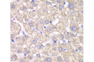 Immunohistochemistry of paraffin-embedded Human liver damage using ACAT1 Polyclonal Antibody at dilution of 1:100 (40x lens). (ACAT1 antibody)