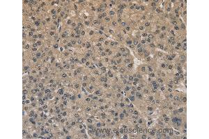Immunohistochemistry of Human liver cancer using DRG1 Polyclonal Antibody at dilution of 1:20