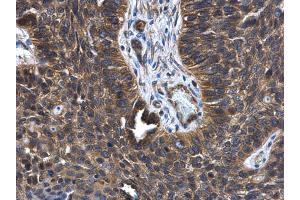 IHC-P Image FGD4 antibody [N1N3] detects FGD4 protein at cytoplasm in human lung cancer by immunohistochemical analysis.