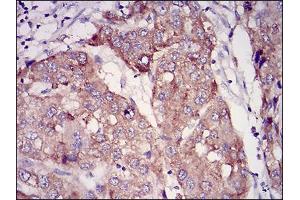 Immunohistochemical analysis of paraffin-embedded liver cancer tissues using RAB27A mouse mAb with DAB staining. (RAB27A antibody  (AA 1-221))
