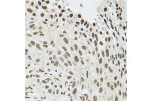 Immunohistochemistry of paraffin-embedded human lung cancer using SFPQ antibody. (SFPQ antibody)