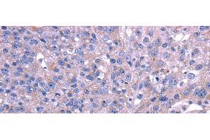 Immunohistochemistry of paraffin-embedded Human breast cancer using TRIM49 Polyclonal Antibody at dilution of 1/40 (TRIM49 antibody)