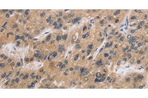 Immunohistochemistry of paraffin-embedded Human liver cancer tissue using CST6 Polyclonal Antibody at dilution 1:30 (CST6 antibody)