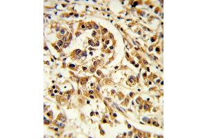 Formalin-fixed and paraffin-embedded human breast carcinoma reacted with IL12A Antibody (C-term), which was peroxidase-conjugated to the secondary antibody, followed by DAB staining. (IL12A antibody  (C-Term))