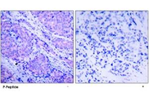 Immunohistochemical analysis of paraffin-embedded human breast carcinoma tissue using PDPK1 (phospho S241) polyclonal antibody . (PDPK1 antibody  (pSer241))
