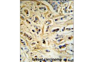 CASA Antibody (RB18742) IHC analysis in formalin fixed and paraffin embedded human breast carcinoma tissue followed by peroxidase conjugation of the secondary antibody and DAB staining. (Casein alpha S1 antibody  (AA 42-70))
