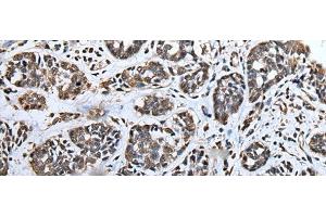 Immunohistochemistry of paraffin-embedded Human esophagus cancer tissue using ATAD1 Polyclonal Antibody at dilution of 1:65(x200)